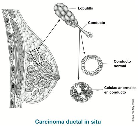 carcinoma ductal in situ